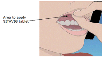 Area to apply the tablet - Illustration