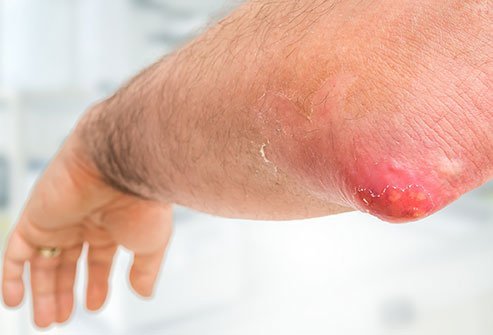 If you have a furuncle, it might grow to the size of a walnut. Abscesses are deeper than boils, so the physical signs might take longer to appear.