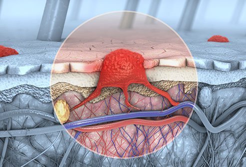 There are three types of skin cancer: basal cell carcinoma, squamous cell carcinoma, and melanoma.