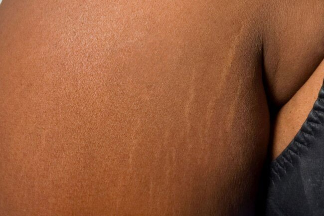 If your stretch marks are old, a cream, oil, or gel isn’t likely to get rid of them.