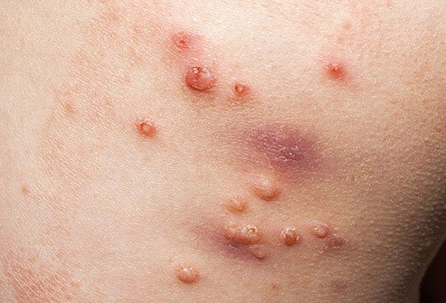 Molluscum contagiosum causes itchy, painful sores.