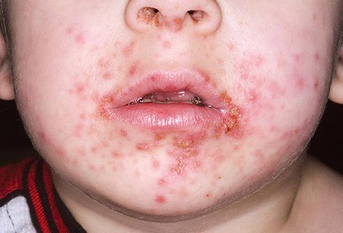 Impetigo is a bacterial infection that sometimes invades the body through a break in the skin.