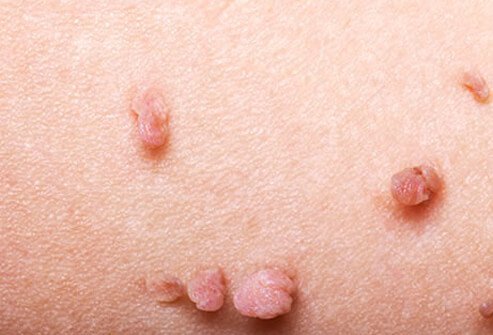Skin tags are flesh-colored growths and are more of a cosmetic issue rather than a health concern.