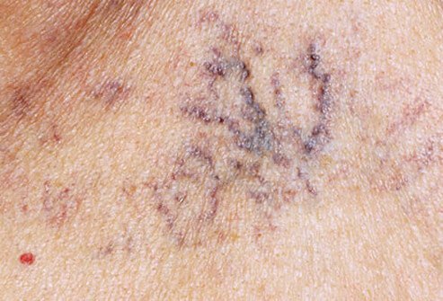 Angiomas are growths of small blood vessels caused by aging.