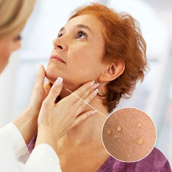 A doctor examines skin tags on a woman's neck.