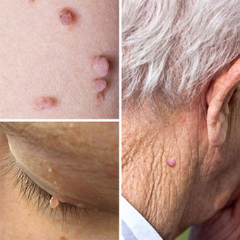 Collage of skin tags on the body, eyelid, and back of the neck.