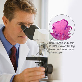 Skin tags examined under a microscope.
