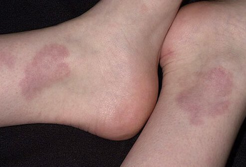 Typical lesions are asymptomatic and ring-shaped with a bumpy edge that can gradually extends outward over a period of months.