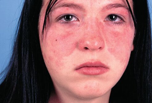The distribution of a rash is often helpful in coming up with a list of possible diseases.