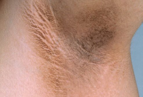 In a young, overweight individual, it may signal a predisposition to diabetes.