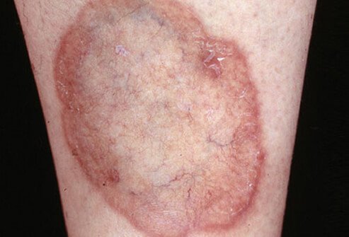 Necrobiosis lipoidica characteristically appears on the shin(s) and has a vaguely circular shape and a brown-yellow color.