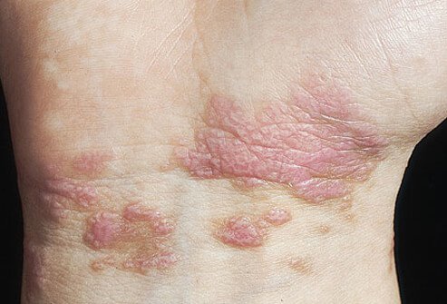 Lichen planus can affect both the skin and the mucous membranes.