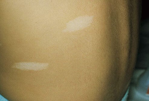 These white patches are devoid of color and often first noted soon after birth.