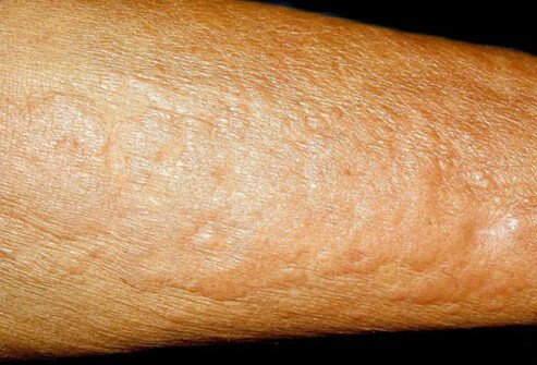 This peculiar thickening of the skin of the arms and legs is unique to some patients who are in renal failure and who have had imaging studies enhanced with gadolinium chloride.