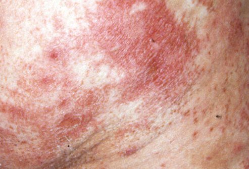 Necrolytic migratory erythema is not an easy diagnosis to make.