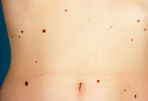 Picture of Dysplastic Nevi (Atypical Moles)