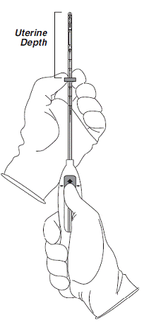 Setting the flange - Illustration