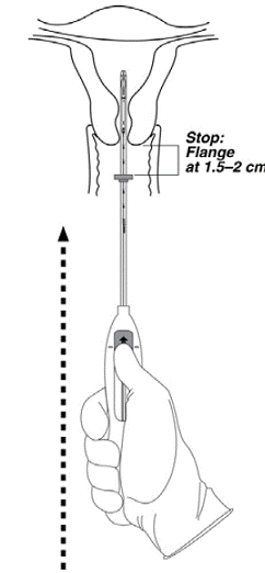 Advancing insertion tube until flange is 1.5
to 2 cm from the cervix - Illustration