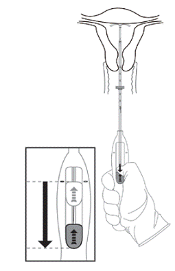 Move the slider
all the way down to release Skyla from the insertion tube - Illustration