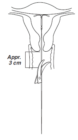 Cutting the threads - Illustration