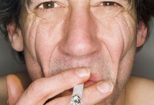 These wrinkles also tend to be deeper in those who smoke.
