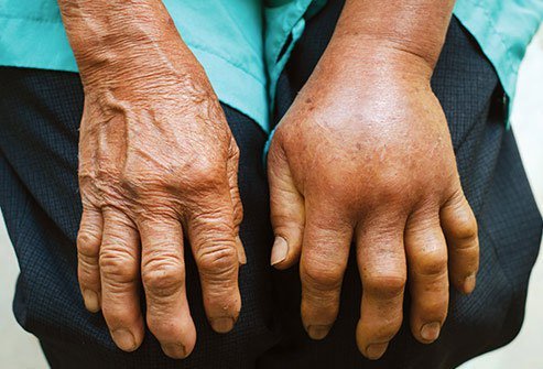 Recommended treatments for snakebites have changed a lot in recent years.