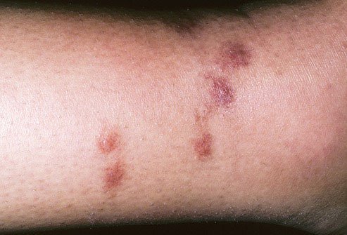 What caused that red, itchy bump on your skin?