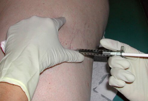 Sometimes the conservative management of spider veins and varicose veins at home may not yield the desired results.