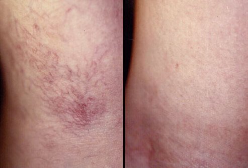 Treatment with sclerotherapy can require multiple treatment sessions, and healing time may vary from person to person.