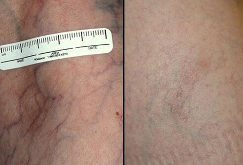 As with sclerotherapy, several sessions are frequently necessary for optimal results with laser therapy.