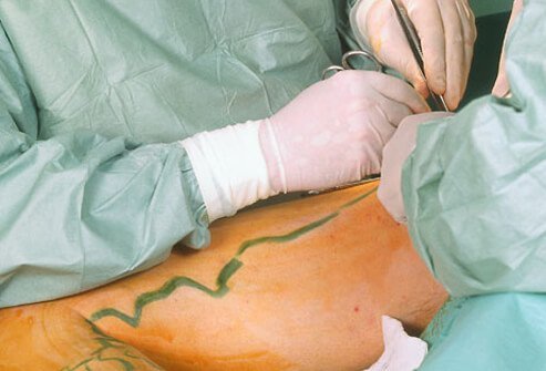 Surgery is an option for more severe cases of varicose veins.