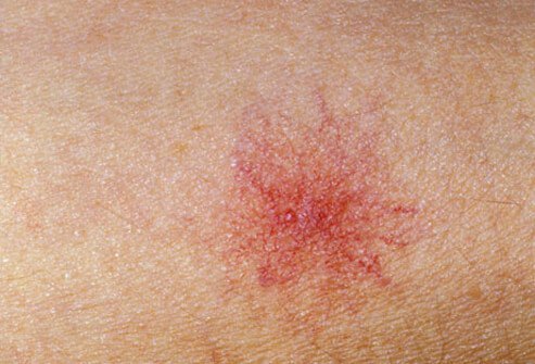 Spider veins (also called telangiectasias) are clusters of tiny blood vessels that develop close to the surface of the skin.