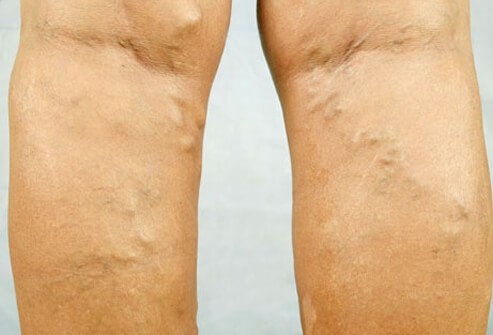 Varicose veins are abnormally enlarged veins that appear most often on the legs.