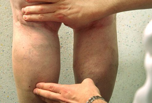 Your health care professional can diagnose spider veins and varicose veins by closely examining the affected areas, which are usually on the legs.