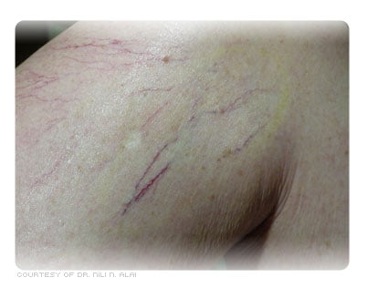 Picture of Spider Veins