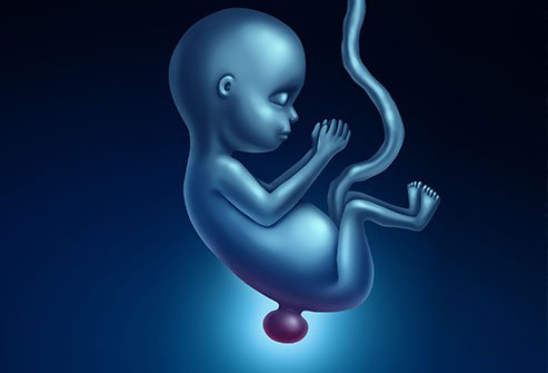 Illustration of a fetus in the womb with spinal bifida (anencephaly, neural tube defects.