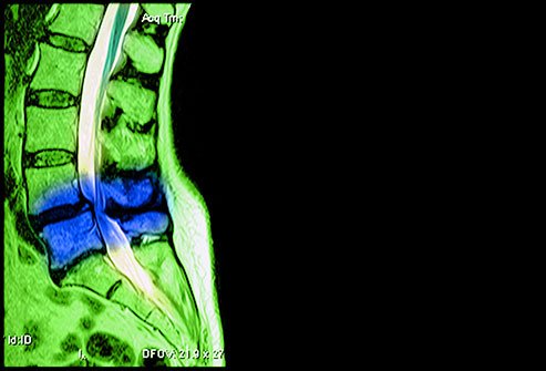 As you age, the chances increase that you will experience a painful disorder caused by the bones or other structures in your back rubbing against your spinal nerve roots.