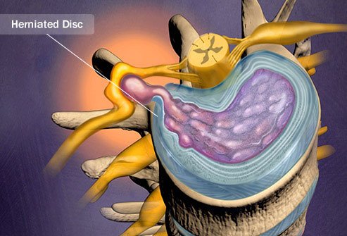 The disorder is usually caused by natural arthritis degeneration as you age.
