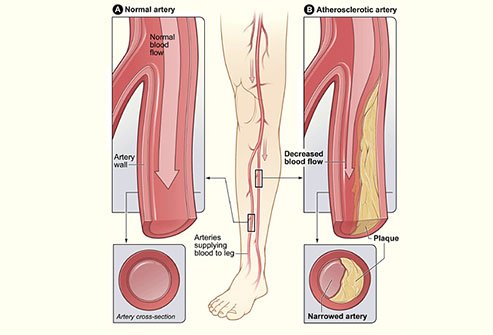 The crimping of your spinal nerves may be confused with problems in your arteries.