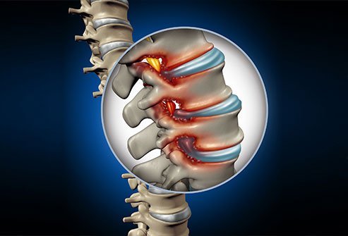 Degenerative disc disease is when the rubbery discs in the spine wear down. Degenerative disc disease is treated with lifestyle changes, medication, alternative therapies and surgery.