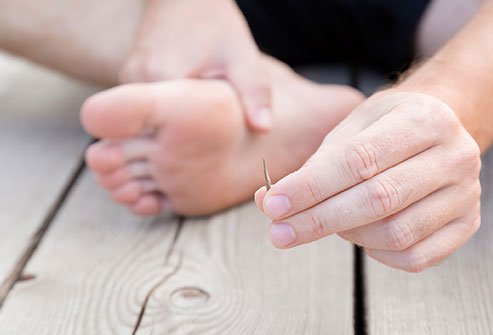 Splinters are usually wood, glass, or metal shards that penetrate your skin. 