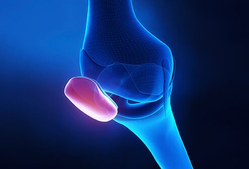An illustration of the knee with the patella highlighted.