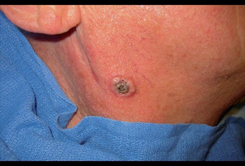 Picture of Squamous Cell Carcinoma (1 of 2)