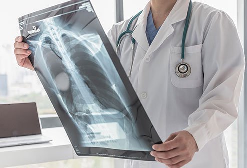 COPD is a group of diseases causing an inflammatory reaction and irreversible damage to the lungs.