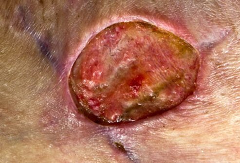 This MRSA (methicillin-resistant <i>Staphylococcus aureus</i>) infection occurred as a complication two years after cosmetic plastic surgery for a breast reduction.