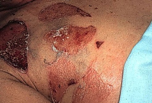 Skin infections can cause a serious condition called scalded skin syndrome.