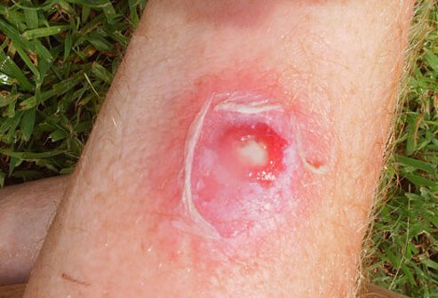 To avoid these infections, you will need to know what to look for.