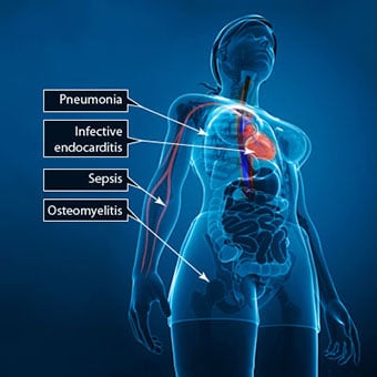 The illustration shows other diseases caused by staph.