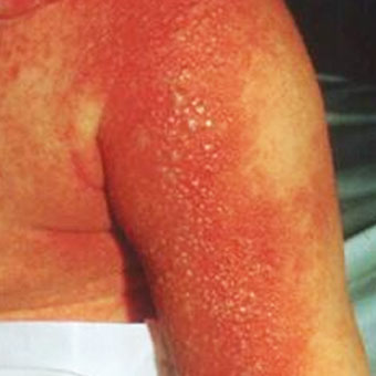 Scalded skin syndrome
