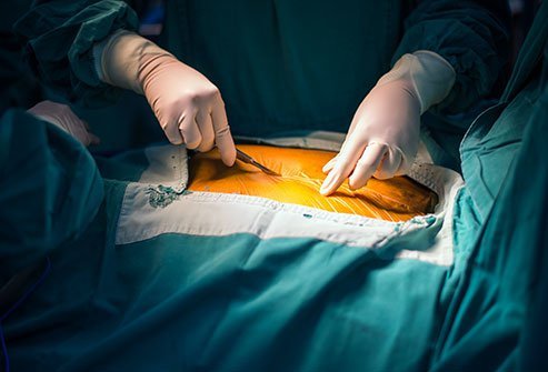 A sternotomy is a surgical opening in the middle of the chest at the breastbone (sternum) to provide access to the chest cavity for heart procedures or other thoracic surgeries.
